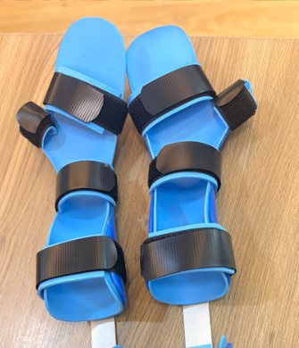 Customized Cock-Up & Forearm Splint